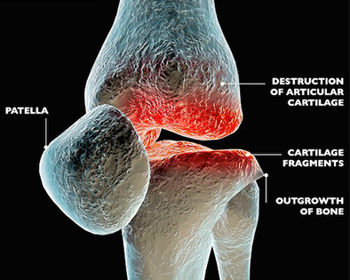 osteoarthritis fórum ízületek és gerinc komplex kezelése