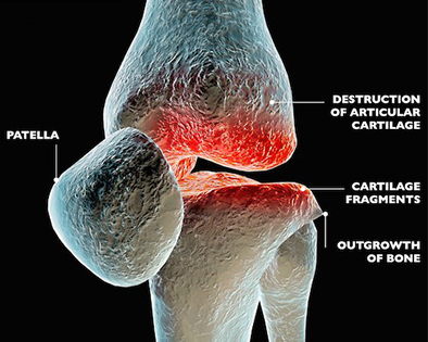 Inflammatory Arthritis