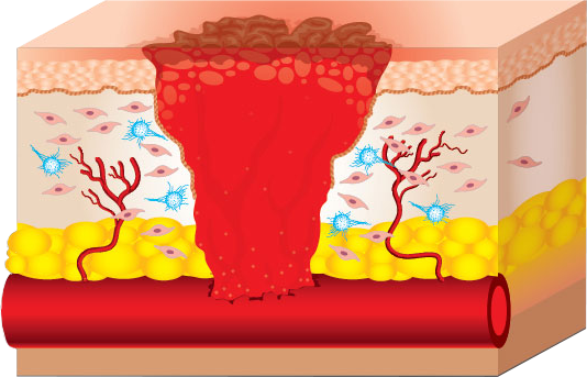 Prolotherapy 1: Inflammation