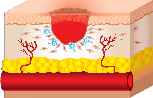 Prolotherapy 1: Proliferation