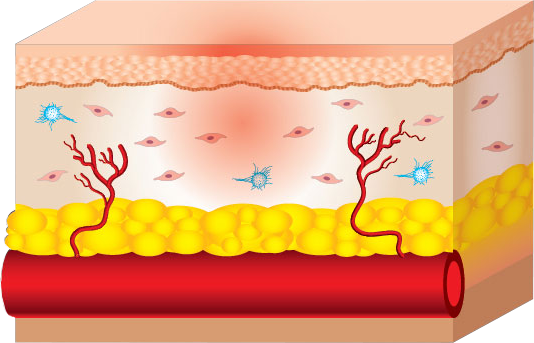 Prolotherapy 1: Tissue Remodeling