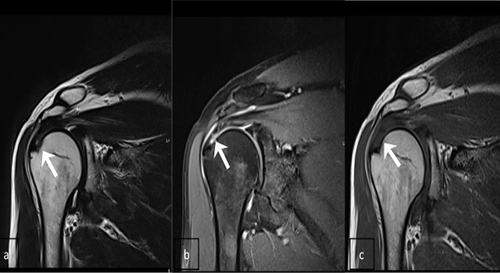 MRI Shoulder